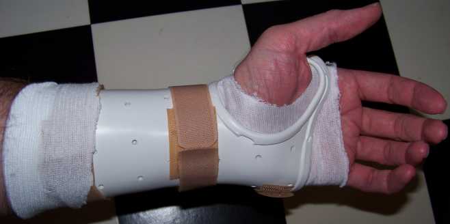 Wrist brace for Carpal Tunnel Syndrome